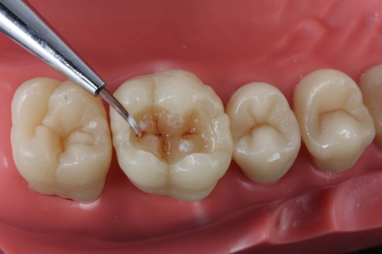Resinas Compostas Dentes Posteriores1 Inspirando Dentistas 8974